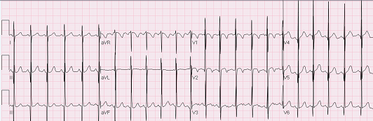 EKG Interpretation