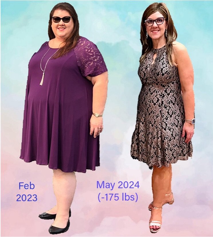 A before and after picture of Felicity Cunningham before her surgery and after when she lost 175 pounds