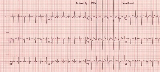 EKG Interpretation